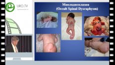Николаев С.Н. - Лечение резистентной внутрипузырной гипертензии у детей с синдромом миелодисплазии