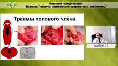 Гамидов С.И. - Оперативные методы лечения болезни Пейрони