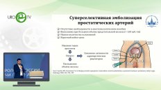 Шапаров Б.М. -  Суперселективная эмболизация простатических артерий в лечении ДГПЖ