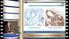 Сивков А.В. - "Определение тактики лечения больных РПЖ с доказанным нейроэндокринным статусом"