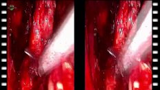 Видеоэндоскопическая экстрафасциальная радикальная простатэктомия. Тазовая лимфоаденэктомия (3D)