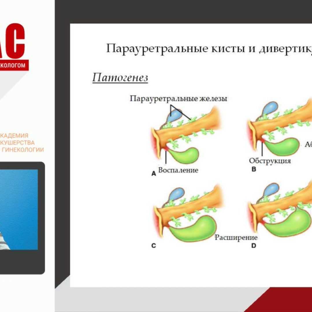 Парауретральная железа у женщин