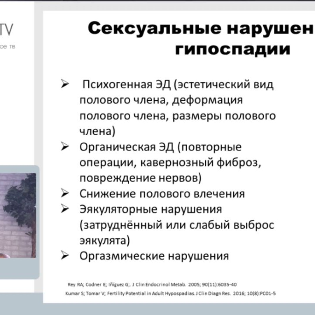 Гамидов С.И. - Репродуктивные и сексуальные нарушения у мужчин после хир  лечения гипоспадии | Урологическое ТВ