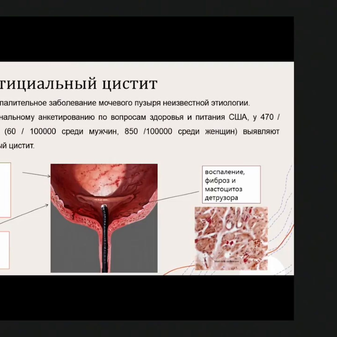 Царёва А.В. - Интерстициальный цистит. Поиск лечебной стратегии |  Урологическое ТВ