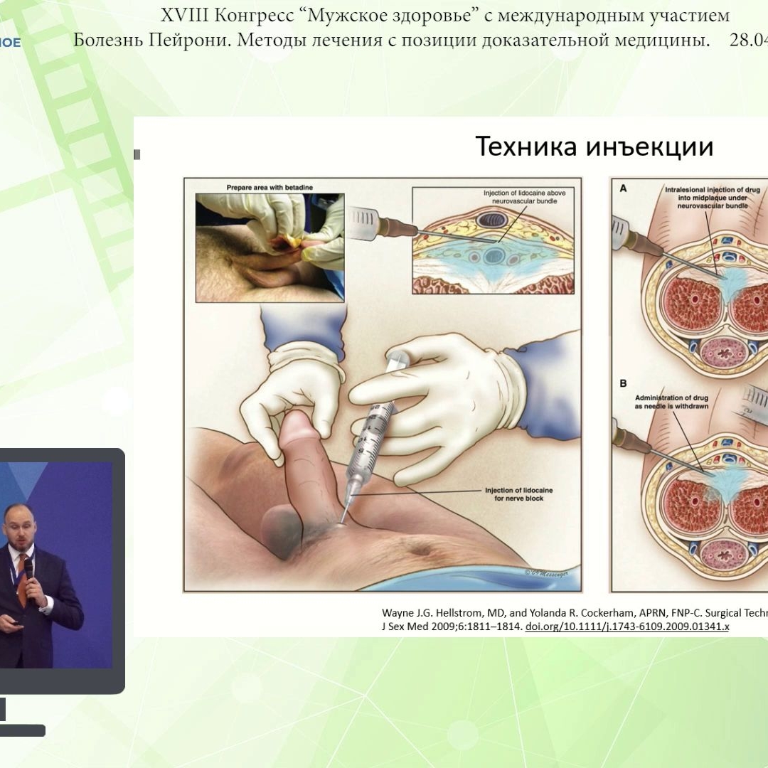 Котов С.В. - Инъекционная, тракционная и ударно-волновая терапия болезни  Пейрони | Урологическое ТВ