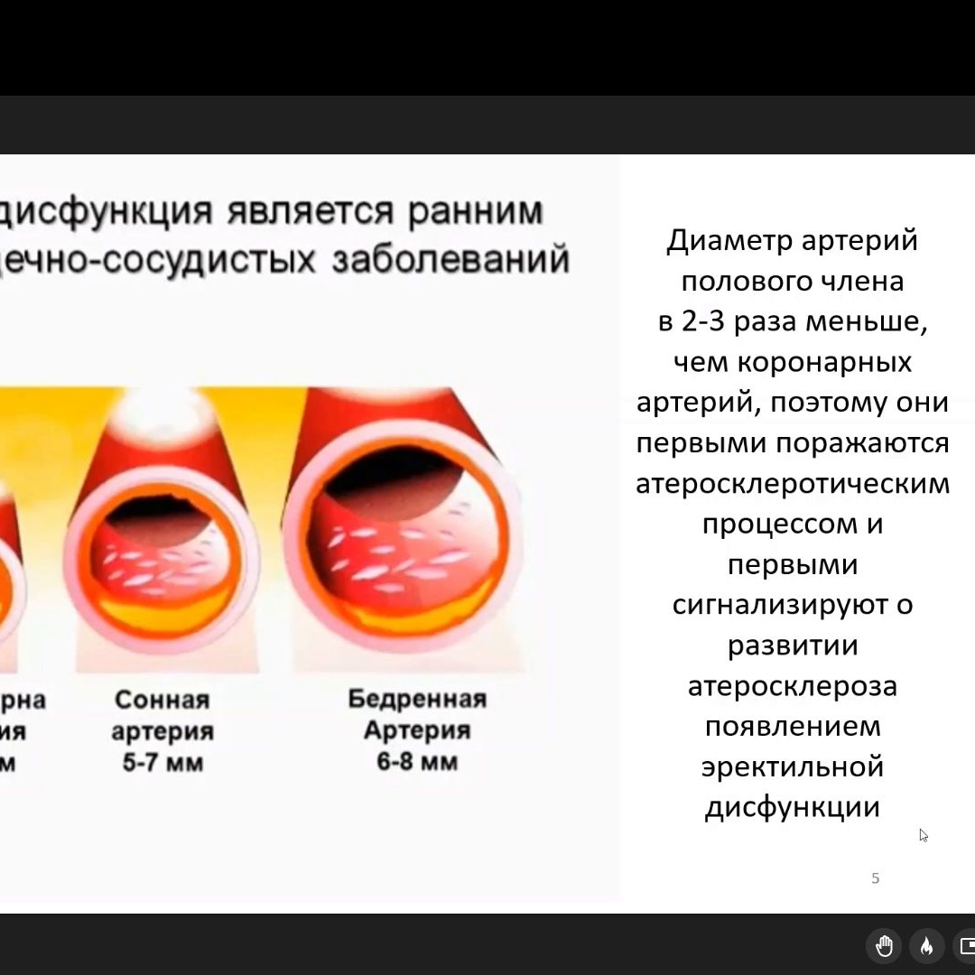 Зырянов А.В. - Гипогонадизм и коморбидные урологические заболевания –  эректильная дисфункция, ДГПЖ, хронический рецидивирующий простатит |  Урологическое ТВ