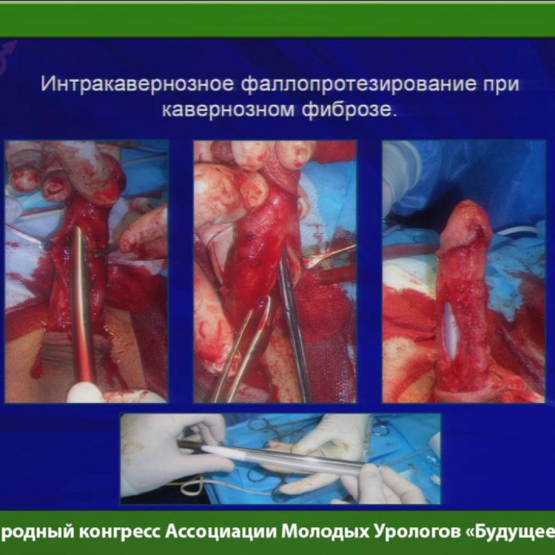 Чем опасен фиброз полового члена?