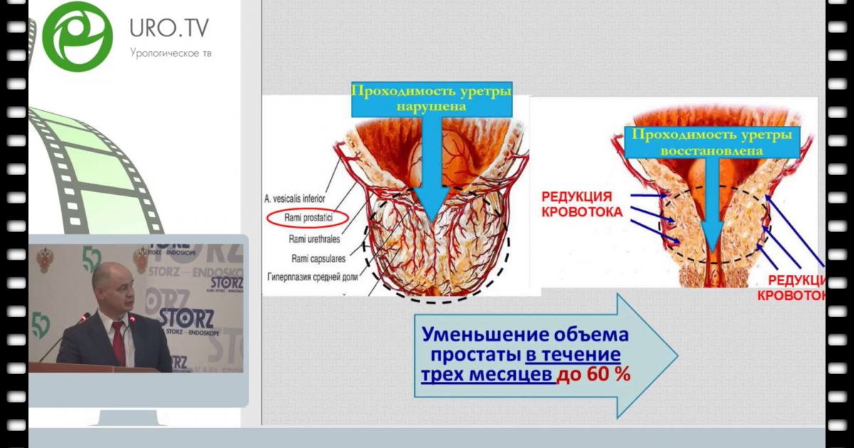 Эмболизация аденомы простаты. Эмболизация артерий простаты. Эмболизация артерий при аденоме простаты. Эндоваскулярная эмболизация в урологии. Методики выполнения эмболизации артерий простаты.