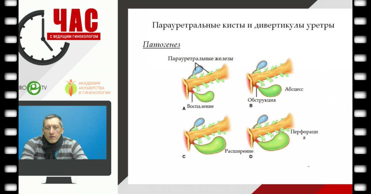 Парауретральная железа у женщин