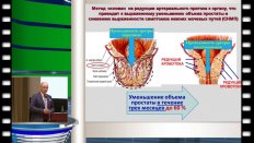 Курбатов Д.Г. - Рентгеноэндоваскулярная хирургия в лечении аденомы предстательной железы