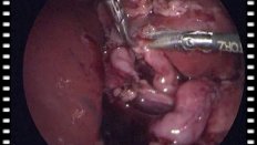 Лапароскопическая коррекция патологии левой удвоенной почки у ребёнка 7 мес