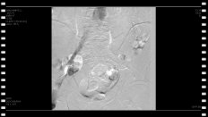 Капто А.А. Рентгенэндоваскулярная ангиопластика и стентирование у мужчины при May-Thurner Syndrome.