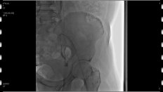 Капто А.А. Рентгенэндоваскулярная ангиопластика и стентирование у мужчины при варикозной болезни вен малого таза.