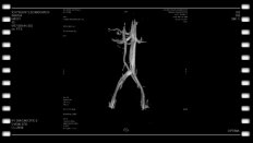 Капто А.А. МРТ, ангиопластика и стентирование у мужчины при May-Thurner syndrome.