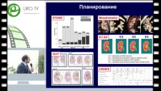 Гаджиев Н.К. - Инновации перкутанной нефролитотрипсии