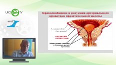 Курбатов Д.Г. - Эмболизация простатических артерий в лечении ДГПЖ