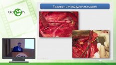 Шевчук А.С. - Технические аспекты тазовой лимфодиссекции