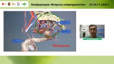 Касян Г.Р. - Сакральная нейромодуляция при идиопатических формах нарушения акта мочеиспускания