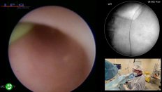 Мартов А.Г. - Ретроградная интраренальная хирургия с использованием нового волоконного инструмента 150 µm