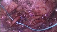 Лапароскопическая пиелопластика справа у пациента 16 лет. Стриктура и добавочный нижнеполярный сосуд.
