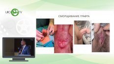 Котов С.В. - Новый подход в многоэтапной уретропластике
