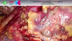 Попов С.В. - Лапароскопическая резекция почки