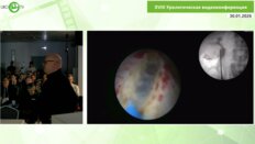 Мартов А.Г. - Трансуретральная хирургия синусной почки