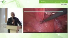 Шкодкин С.В. - Нейрогенная дисфункция мочевого пузыря и рецидивная стриктура левого мочеточника, лапароскопическая пластика