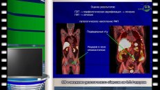 Андабеков Т.Т. - "Возможности применения ПЭТ с 11-холином в диагностике рецидива рака предстательной железы у больных после радикальной простатэктомии "
