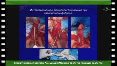Садакова И.В. - "Комбинированная методика лечения пациентов с кавернозным фиброзом"