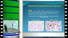 Горелов А.И. - "Прогностическое значение маркеров Ki-67 и Vimentin у больных с метастатическим раком почки"