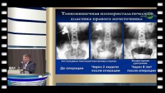 Комяков Б.К. - "Интеграция урологии и абдоминальной хирургии. Желудочно-кишечная реконструкция мочевых путей"