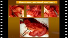 Реконструктивно-восстановительная хирургия мочеточника