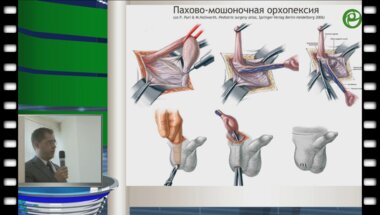 Игнатьев Р.О. - Хирургические методы лечения крипторхизма у детей