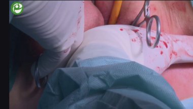 Реконструкция тазового дна при цистоцеле 3 ст. с апикальным пролапсом 3-4 ст.