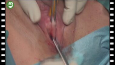 Имплантация синтетического субуретрального слинга при недержании мочи