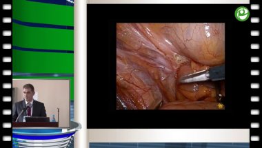 Кочкин А.Д. - Лапароскопическое иссечение пузырно-кишечного свища