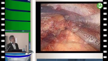 Сергеев В.П. - Левосторонняя циторедуктивная нефрэктомия с резекцией грудины, оментопластикой и аллопротезированием