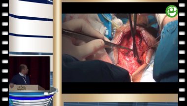 Бутнару Д.В. - Буккальная мышце-нервсберегающая пластика стриктуры бульбозного отдела уретры