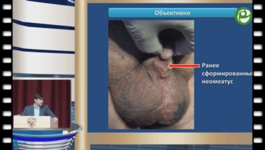 Глухов В.П. - Гипоспадия. Осложнённый калькулезный дивертикул неоуретры. Уретропластика