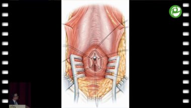 Гуспанов Р.И. - Решения в сложных случаях при выполнении бульбо-простатического анастомоза