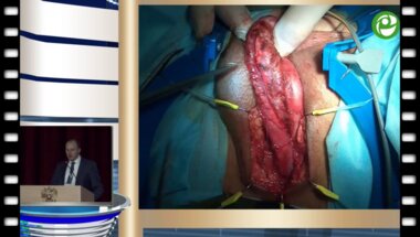 Котов С.В. - Протяженная стриктура уретры - операция Kulkarni