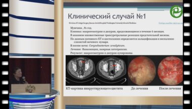 Синякова Л.А. - Инкрустирующий цистит у мужчин