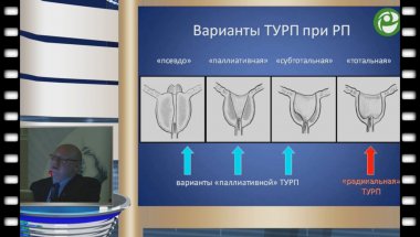 Мартов А.Г. - Трансуретральная простатвезикулэктомия в лечении рака предстательной железы