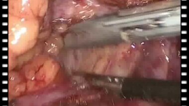 Гулиев Б.Г. - Лапароскопическая геминефруретерэктомия справа