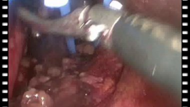 Гулиев Б.Г. - Лапароскопическая геминефрэктомия справа