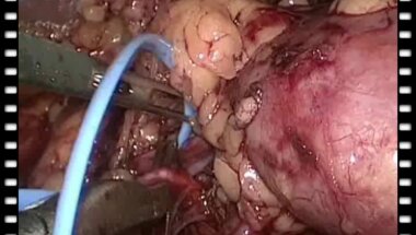 Гулиев Б.Г. - Лапароскопическая резекция почки (селективный артериальной зажим )