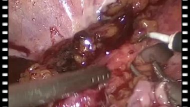 Гулиев Б.Г. - Лапароскопическая процедура Боари