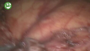 Лапароскопическая монопортовая нефрэктомия