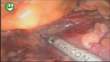 Лапароскопическая резекция левой почки с опухолевым узлом